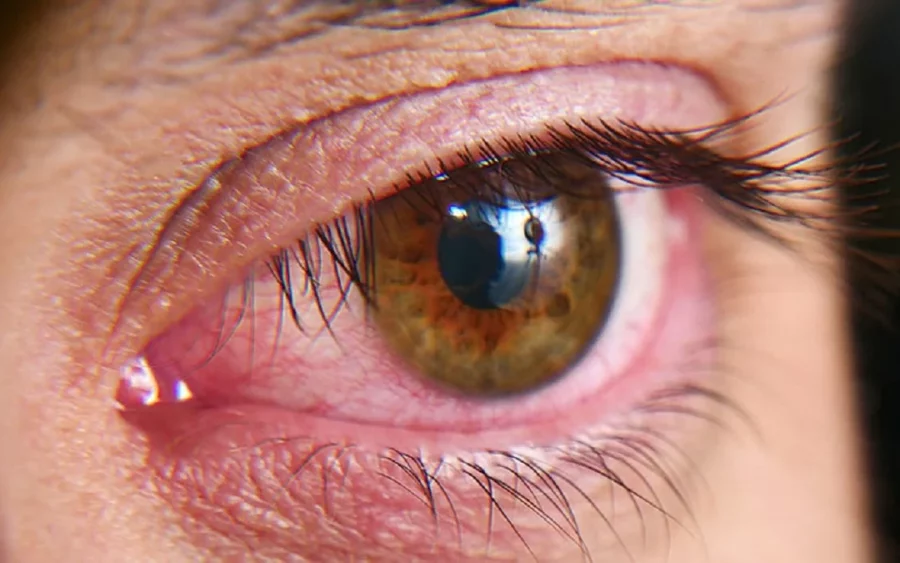Características de un ojo seco.