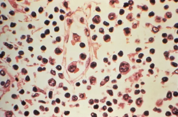 hantavirus2